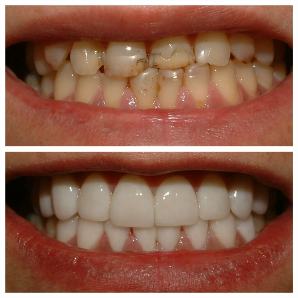 Facettes dentaires avant après